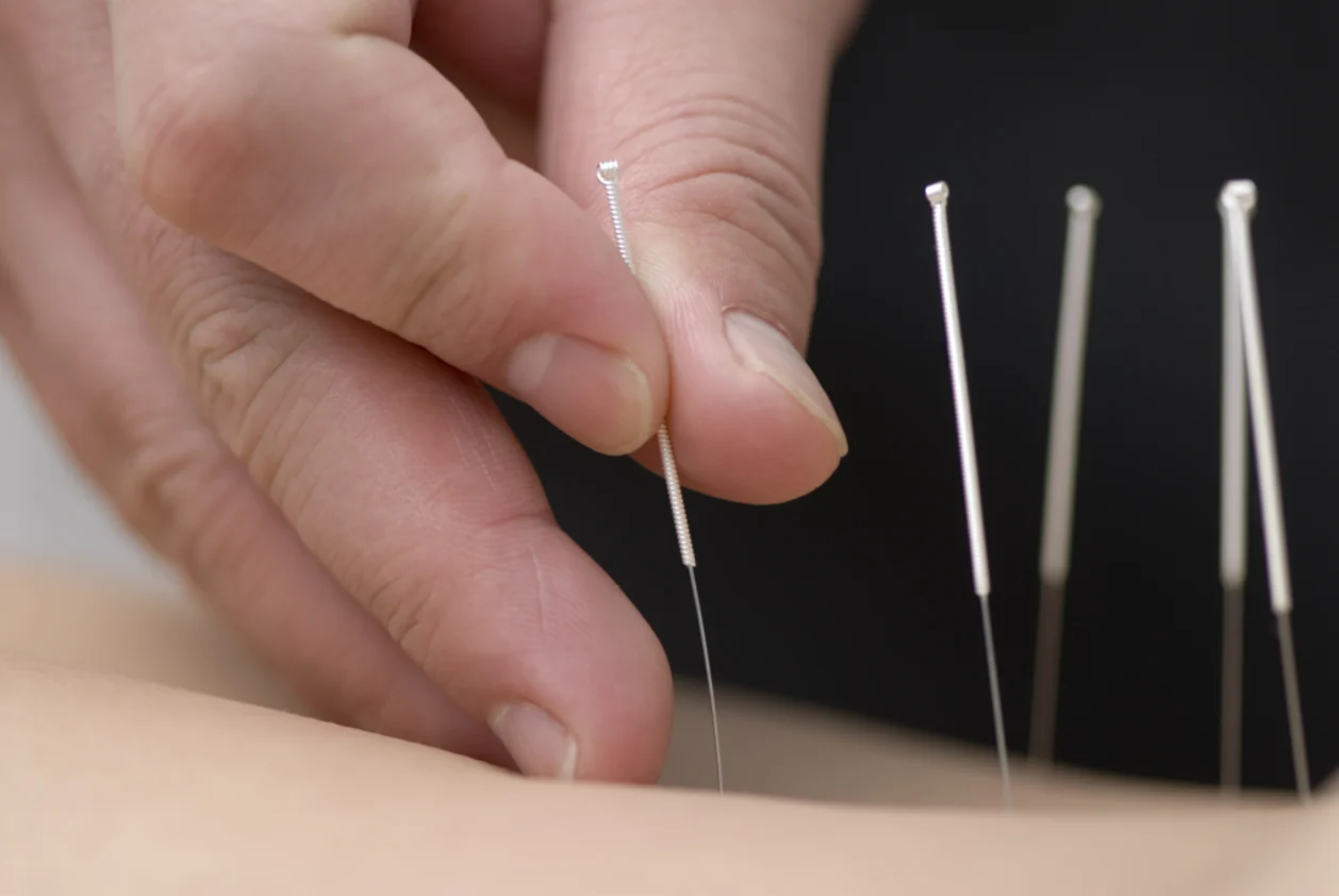 Treatment by acupuncture